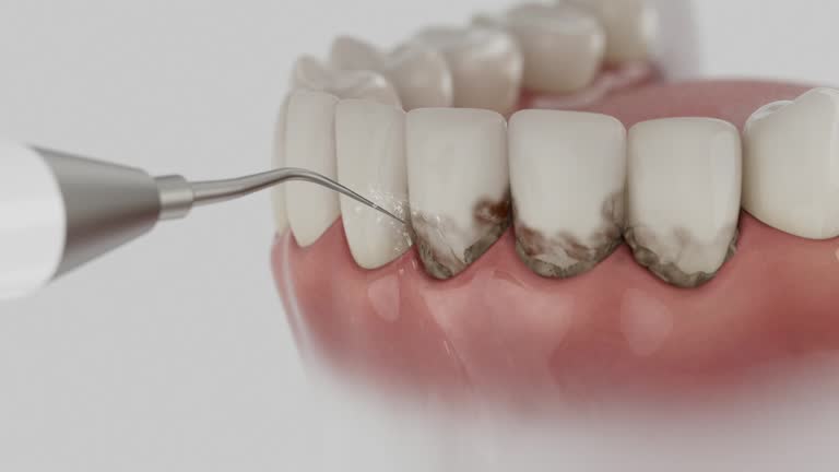 Trusted Dental Crowns And Bridges service in Purdy, WA - Dentist Open Now